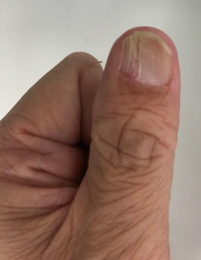 Nail-Patella Syndrome Thumb